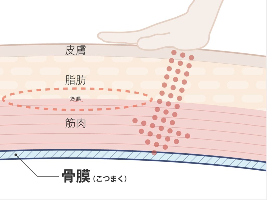 骨膜リリース図解